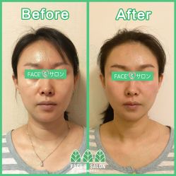 -FACE·日本小颜矫正美容整骨サロン