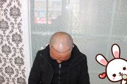 -大麦微针植发丨全国连锁