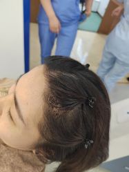 -大麦微针植发全国连锁