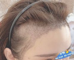 -大麦微针植发丨全国连锁