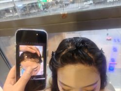 -碧莲盛·不剃发植发