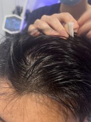 体验后-熙朵美学植发·连锁品牌