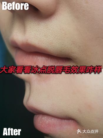 大家看看冰点脱唇毛效果咋样