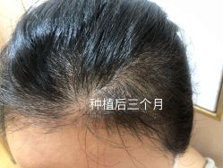 体验后-熙朵美学植发连锁