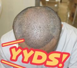 -大麦微针植发丨全国连锁