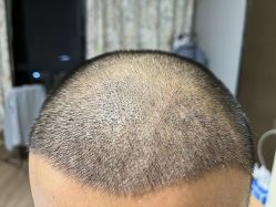 -大麦微针植发全国连锁