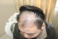 -大麦微针植发全国连锁