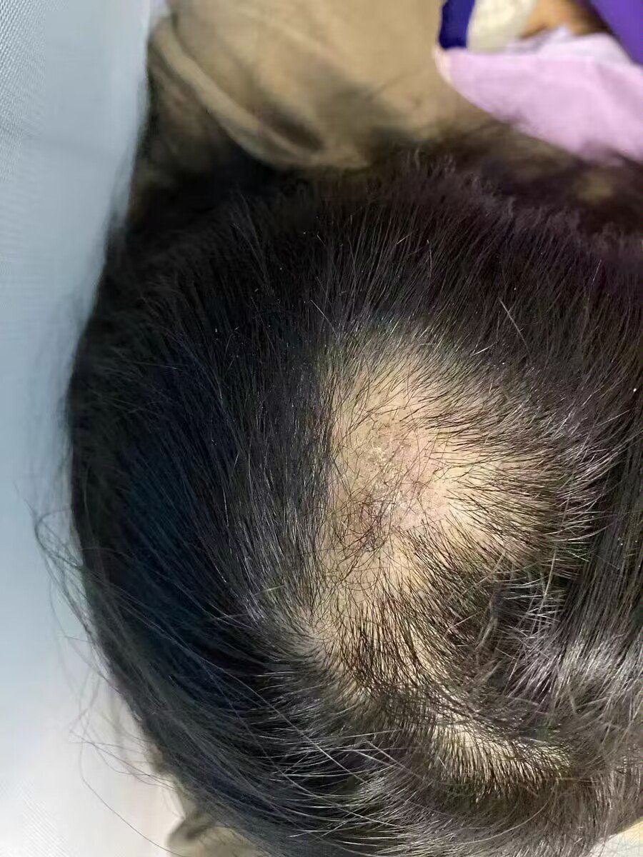 女性头顶脱发