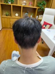 体验后-大麦微针植发全国连锁