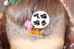 -大麦微针植发全国连锁