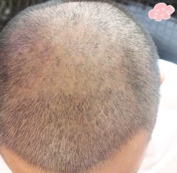 -大麦微针植发丨全国连锁