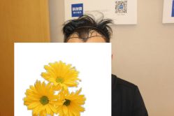 -大麦微针植发丨全国连锁