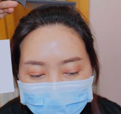 点击看大图 体验后-大麦微针植发全国连锁