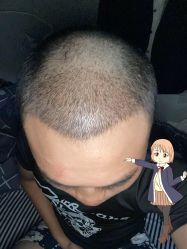 -大麦微针植发丨全国连锁