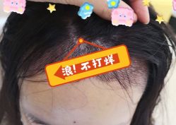 -大麦微针植发全国连锁