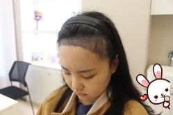 -大麦微针植发丨全国连锁