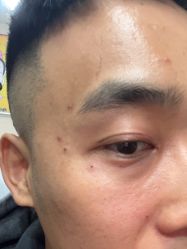 -北京美痣堂古方祛痣斑疣瘊