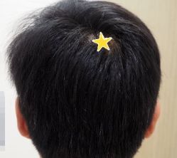 -大麦微针植发丨全国连锁