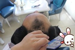 -大麦微针植发丨全国连锁