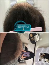 -菩叶脱发白发中心
