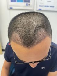 体验后-大麦微针植发全国连锁