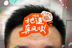 -大麦微针植发全国连锁