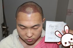 -大麦微针植发丨全国连锁