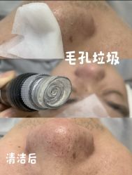 -木棉问题肌·肩颈·纹绣