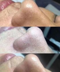 -瑶芳清颜草本祛痘