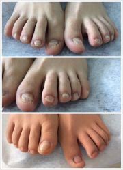 -德哥灰指甲脚气甲沟炎跖疣护理