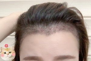 -大麦微针植发丨全国连锁