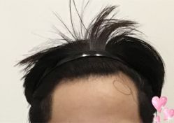-大麦微针植发全国连锁