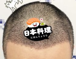 -大麦微针植发全国连锁