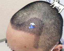 -大麦微针植发全国连锁