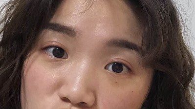 -天津健丽·去眼袋医疗美容机构