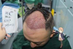 -大麦微针植发丨全国连锁