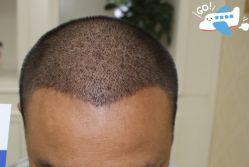 -大麦微针植发丨全国连锁