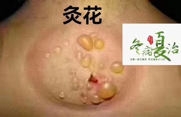 —灸花
学名灸花,俗称水泡
我一艾灸就出水泡