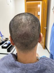 体验后-大麦微针植发全国连锁