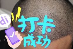 -大麦微针植发全国连锁