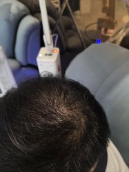 -碧莲盛·不剃发植发