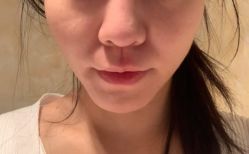 体验后-洁铭新加坡医美