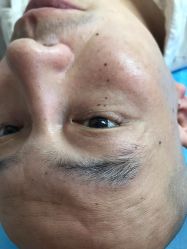 体验前-美丽人生祛斑扁平疣汗管瘤中心