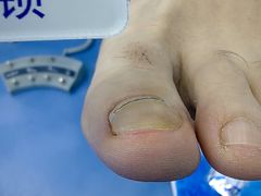 -Andrew指甲专科灰指甲·甲沟炎矫正·3D步态矫形鞋垫定制(浦三路店)