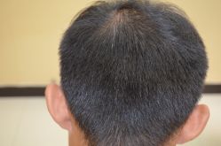 -大麦微针植发丨全国连锁