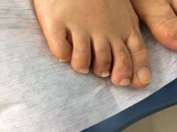 -德哥灰指甲脚气甲沟炎跖疣护理