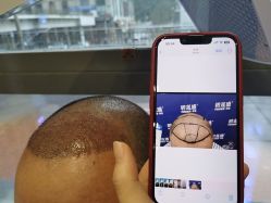 -碧莲盛·不剃发植发