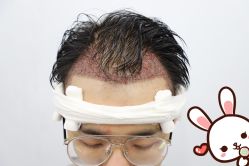 点击看大图 -大麦微针植发丨全国连锁