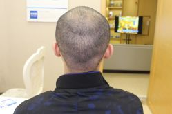 -大麦微针植发丨全国连锁