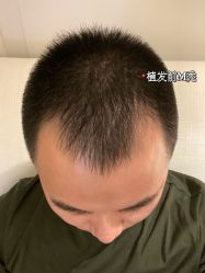 -北京雍禾植发医院